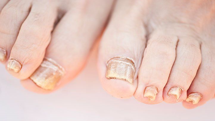 Things You Need to Know About White Superficial Onychomycosis Treatment